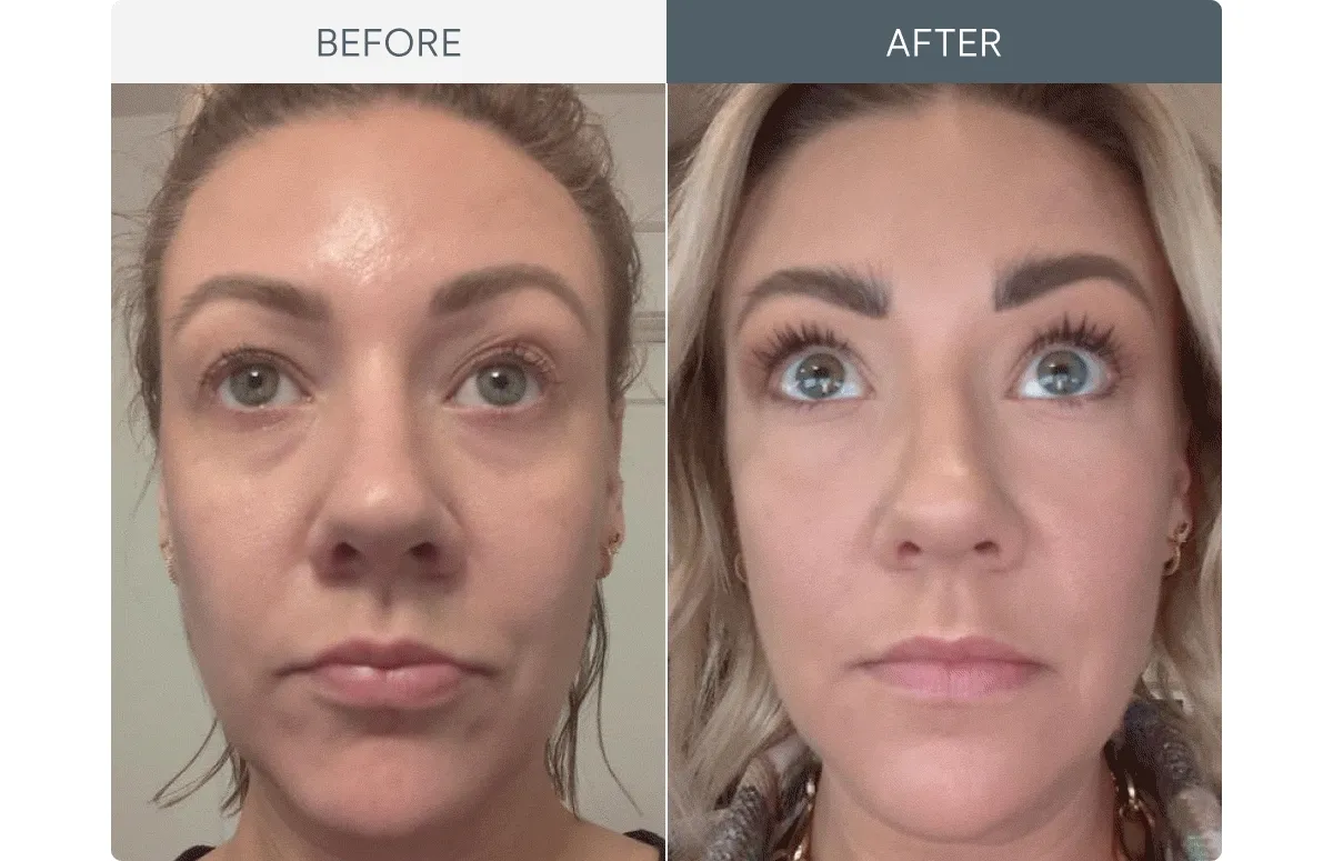 Before & After Preview