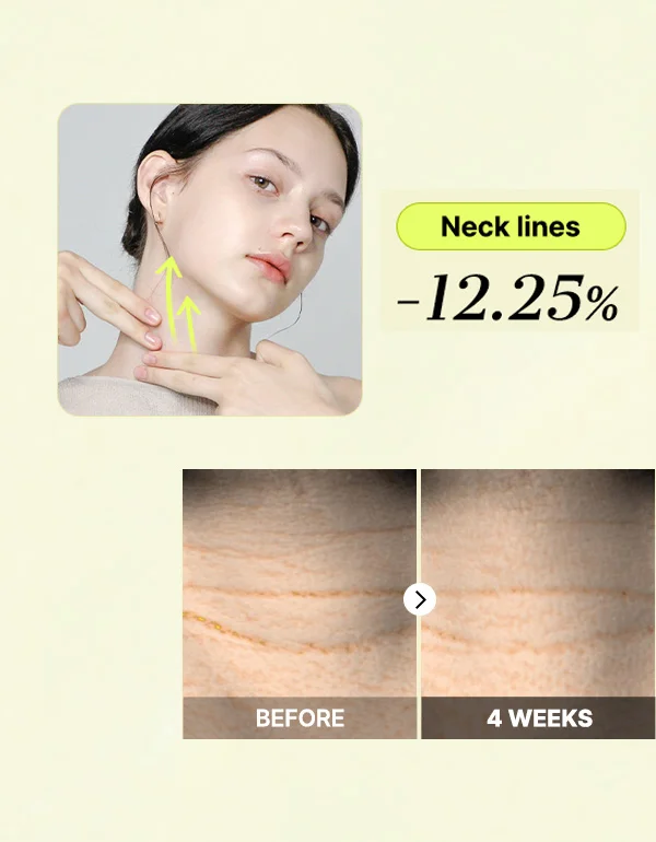 /Clinical Results in 4 weeks/ -12.25% Neck lines decreased