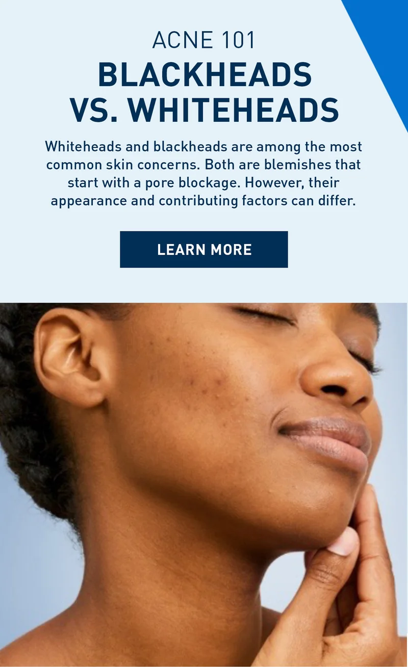 ACNE 101