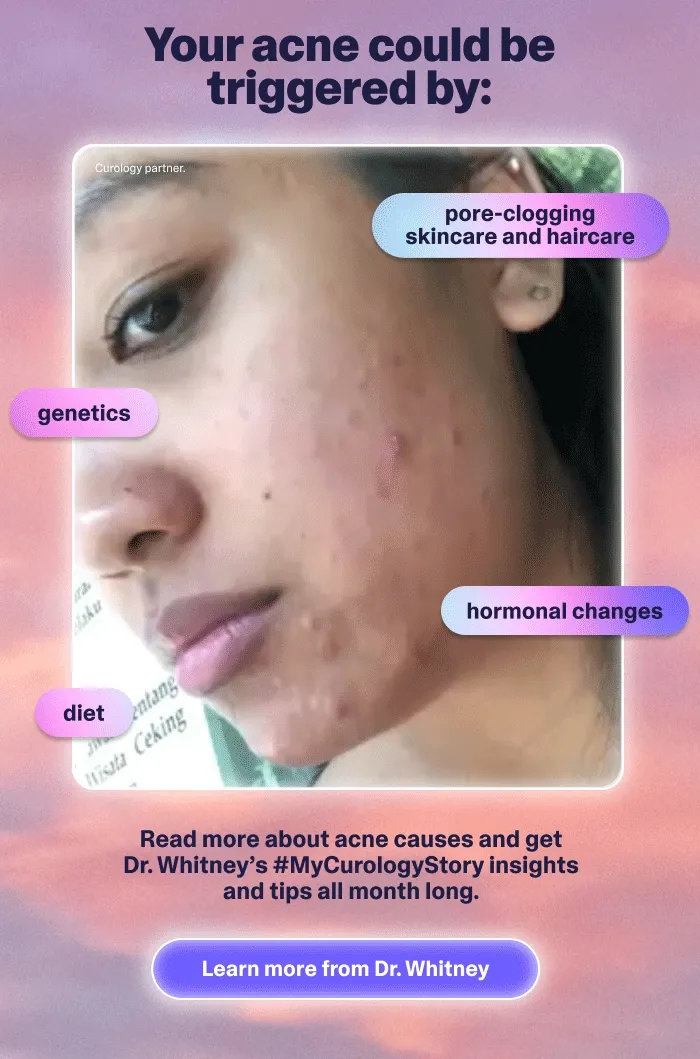 Read more about acne causes