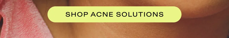 Shop acne solutions!