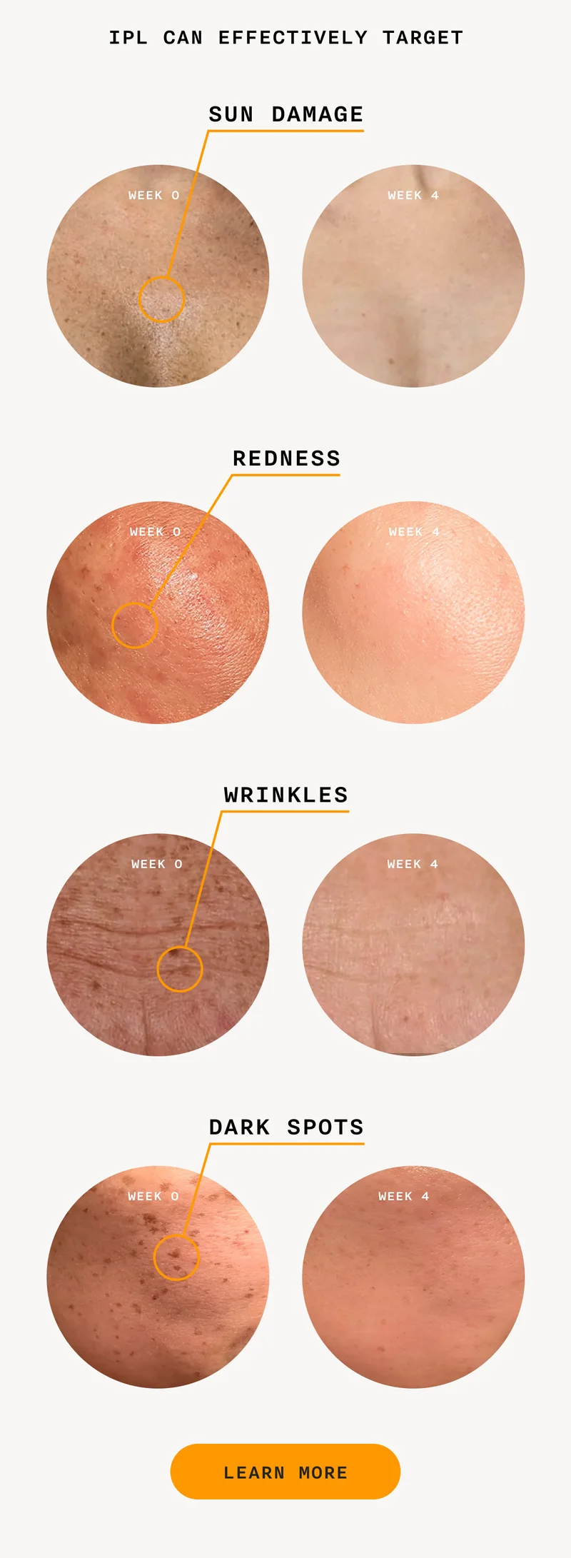 IPL Can Effectively Target: Sun Damage, Redness, Wrinkles, Dark Spots - LEARN MORE